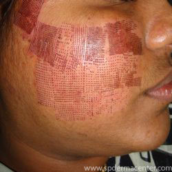 Acne Scar Co2 Fraxel